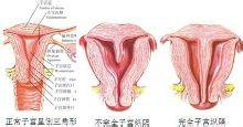 懷孕時查出子宮縱膈怎麼辦