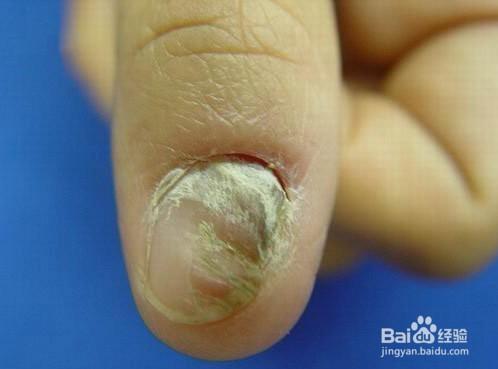 灰指甲治療對比