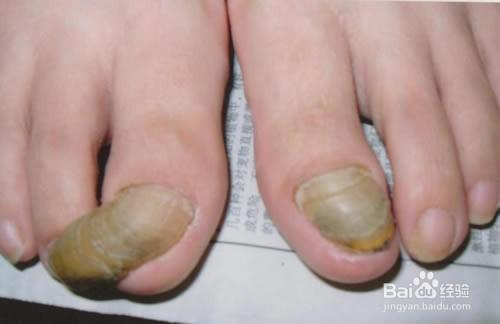 灰指甲治療對比