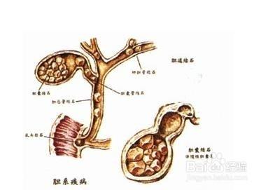 膽囊結石該怎麼辦？