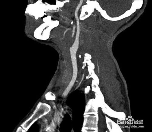 頸動脈血管造影圖譜：[1]正常頸動脈血管造影