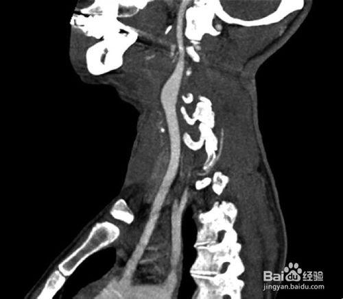 頸動脈血管造影圖譜：[1]正常頸動脈血管造影