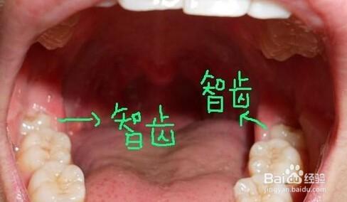 拔掉智齒\阻生牙的流程步驟