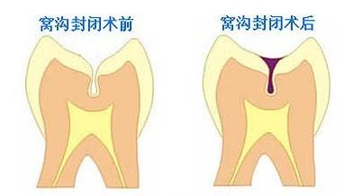 給孩子做窩溝封閉的重要性