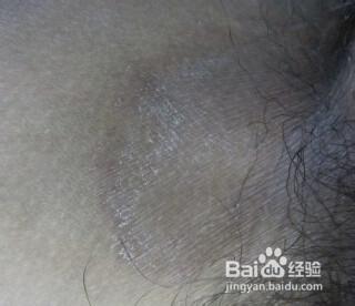 大腿內側股癬怎麼治？塗了很多藥膏面板很黑？