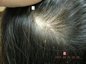 頭皮屑多是什麼原因？怎樣預防及治療頭皮屑？