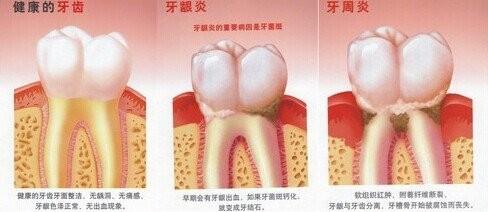 如何認識牙齦炎和怎樣去維護牙齦出血