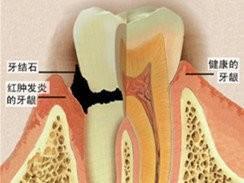 如何認識牙齦炎和怎樣去維護牙齦出血