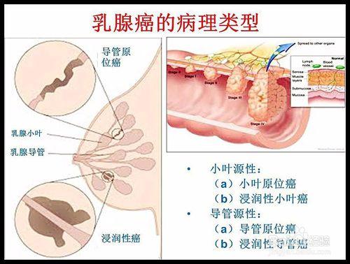 乳腺癌的病理報告怎麼看？