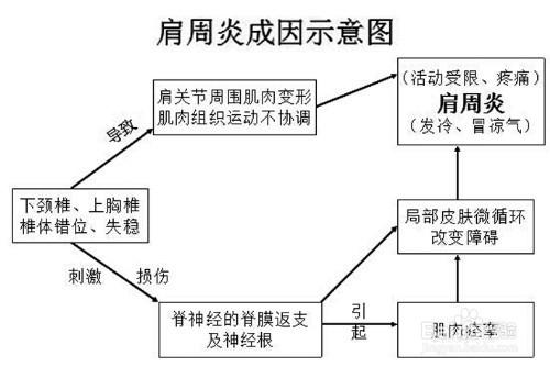 一招妙計教你治好肩周炎。