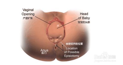 順產側切傷口護理方法？應該如何護理？