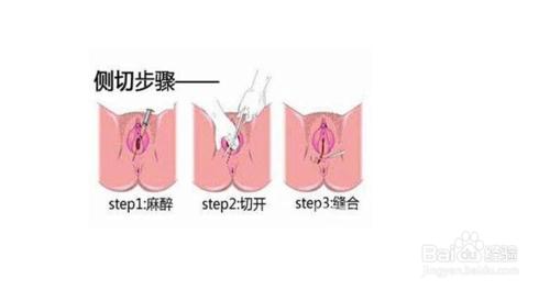 順產側切傷口護理方法？應該如何護理？