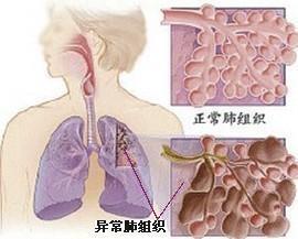 得了間質性肺炎如何保養