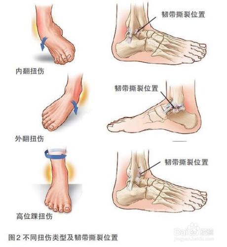 腳踝外翻損傷適合用哪種護踝產品？