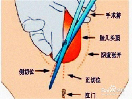 產婦側切傷口護理