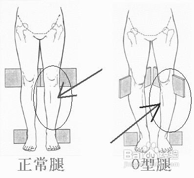 綁腿可以矯正o型腿嗎？