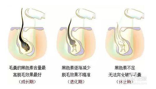 使用家用鐳射脫毛儀的使用步驟和療程