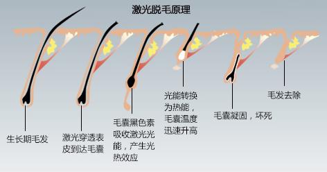 使用家用鐳射脫毛儀的使用步驟和療程