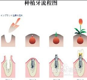 種植牙治療過程