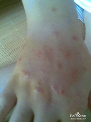 手部溼疹病因主要有哪些