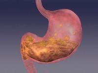 胃潰瘍如何注意飲食