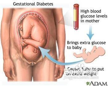 妊娠糖尿病的診斷標準是什麼