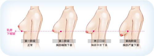 日常生活有哪些不良習慣會引起乳房下垂？