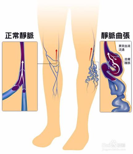 靜脈曲張怎麼緩解怎麼根治