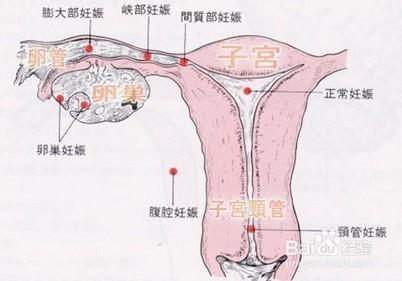 宮外孕是怎麼形成的原因