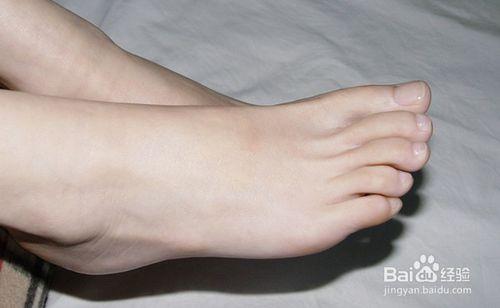 腳底乾燥脫皮怎麼辦 腳氣脫皮的治療方法(實用)