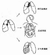 肺結核的傳播途徑主要是什麼