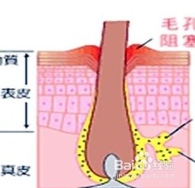 什麼方法可以消除青春痘