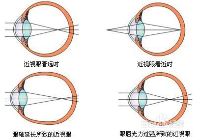 中醫方法不花錢讓你治療高度近視