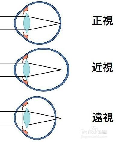 中醫方法不花錢讓你治療高度近視