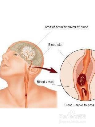 腦血栓病人的二級防護