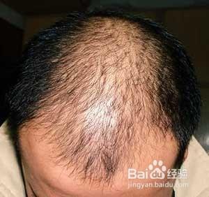 防止男性脫髮的有效方法