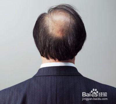 防止男性脫髮的有效方法