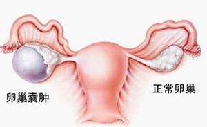 卵巢囊腫怎麼治？要開刀嗎？