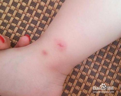 兒童使用驅蚊液好不好？需要注意哪些問題？