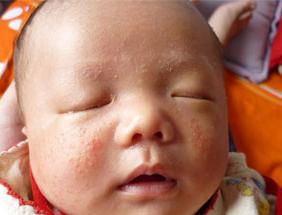 新生兒為什麼會長溼疹及新生兒溼疹的治療方法