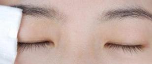 如何讓正確貼雙眼皮讓單眼皮變大變雙