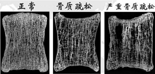 垂直律動運動在預防骨質疏鬆的妙用