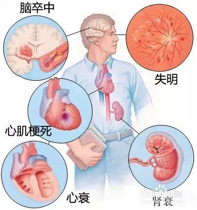 高血壓患者運動知多少