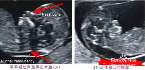 唐篩報告怎麼看