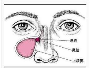 兒童突然流鼻血該怎麼辦？