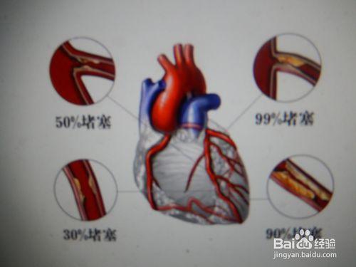 動脈硬化怎麼治療