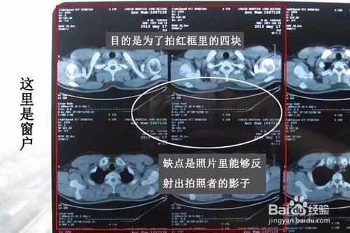 如何用手機拍照醫院檢查的影像片子