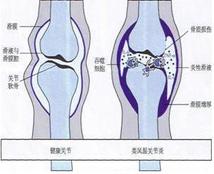 類風溼如何治癒