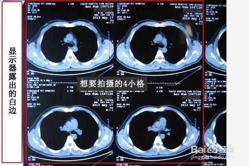 如何用手機拍照醫院檢查的影像片子