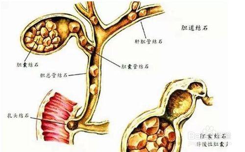 體檢發現膽囊結石需要手術嗎？